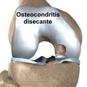 osteocondritis disecante 1