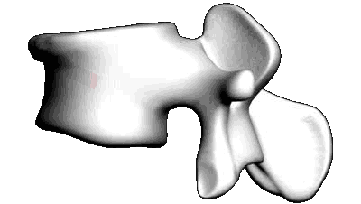 Fractura vertebral Vexim