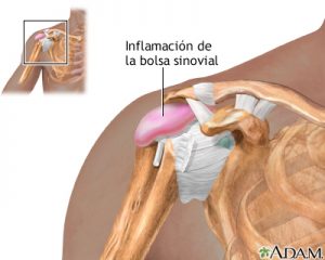 bursitis hombro