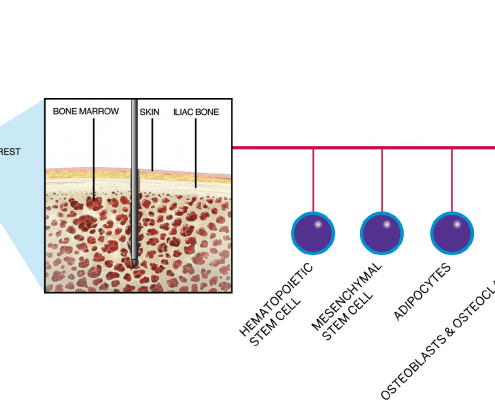 Extracción células Médula ósea