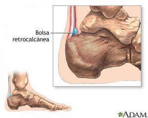 Bursitis retrocalcanea