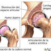 artrosis cadera