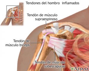 Tendinitis manguito Rotador 1